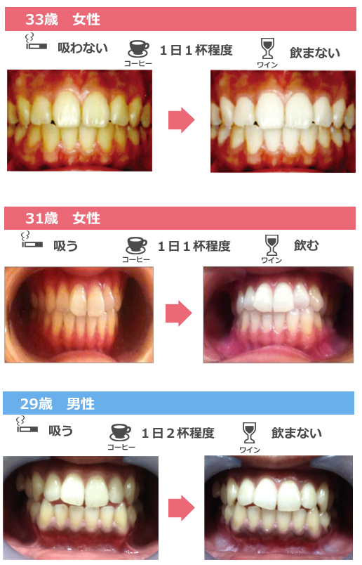 セルフホワイトニング施術例